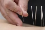 Acupunctura